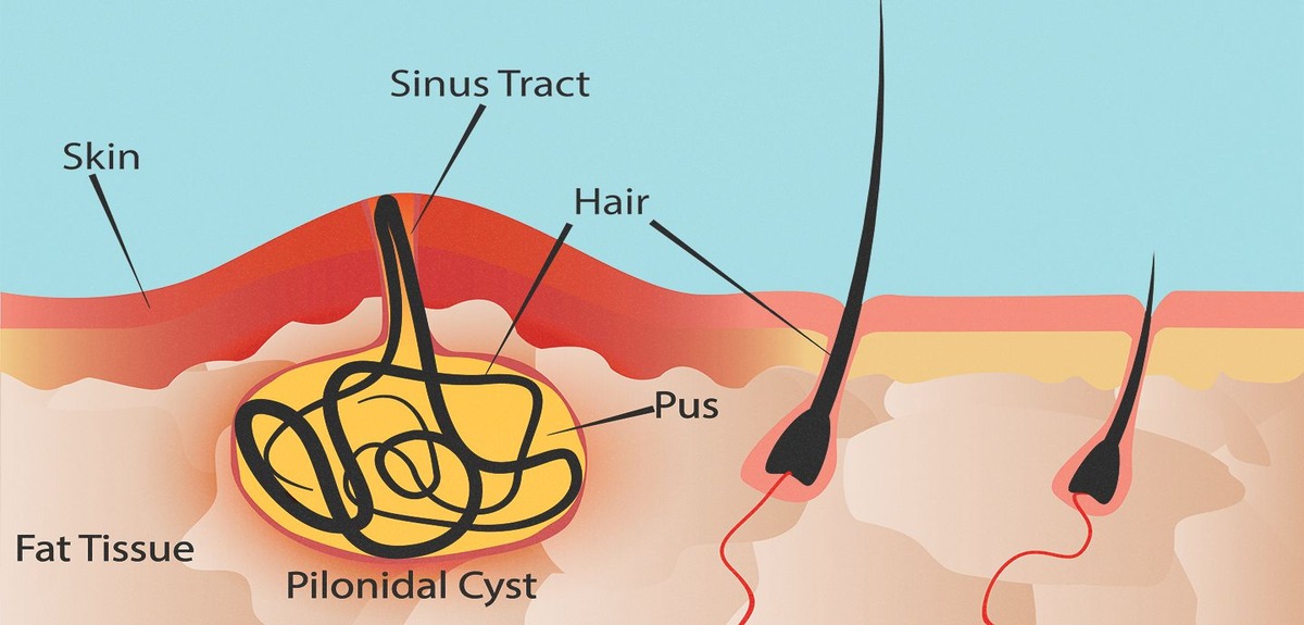 what is a pilondial cyst 1440x810 1