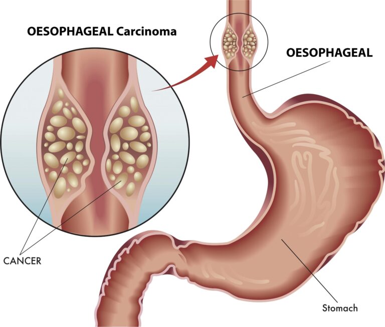 Esophageal cancer