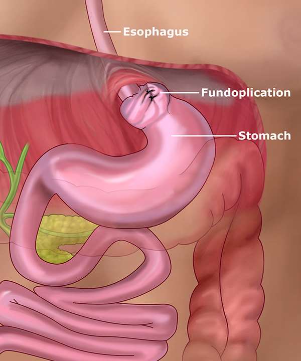 nissenfundoplication