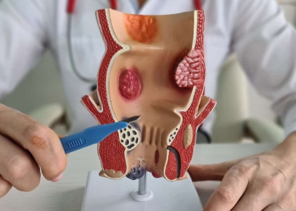 Difference Between Hemorrhoids and Colon Cancer: Know the Signs