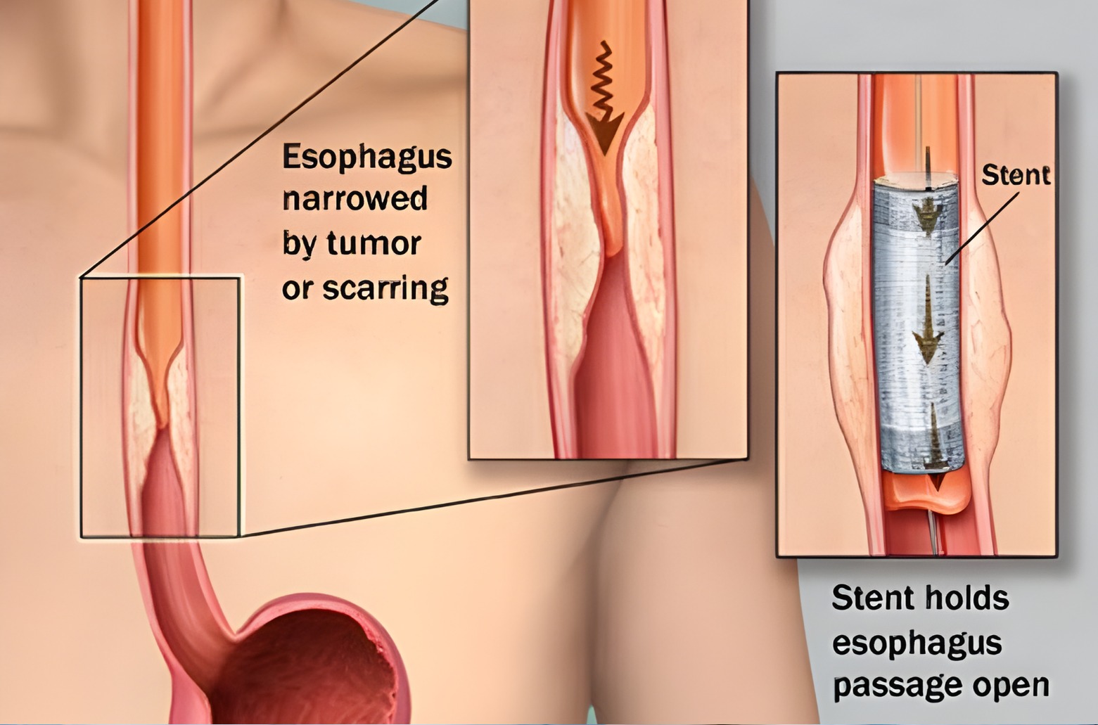 Esophageal Surgery