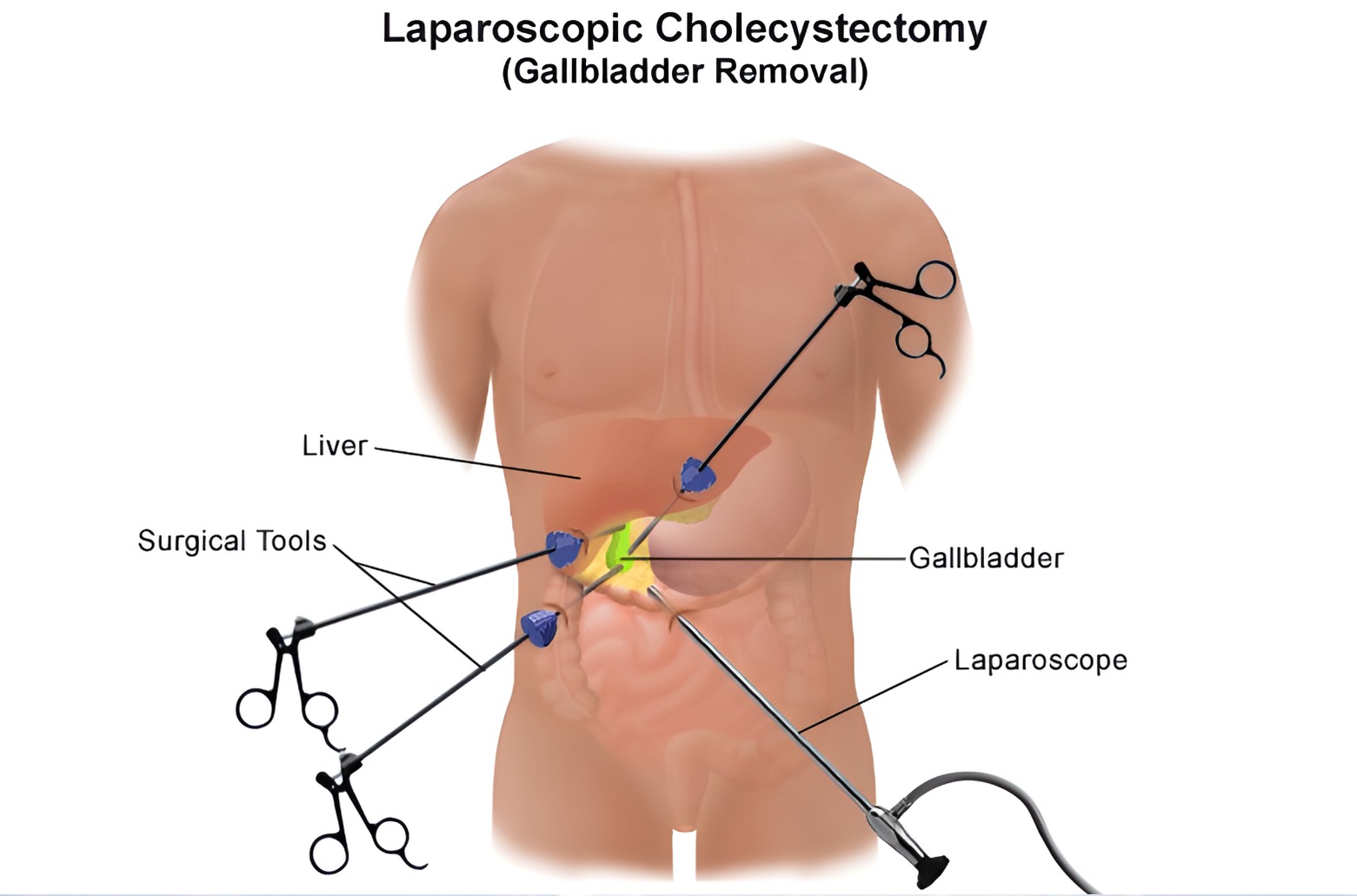Gall Bladder Surgery