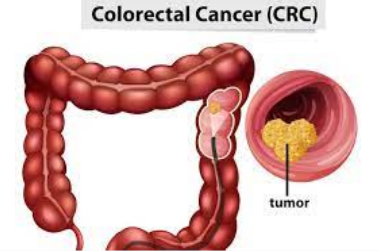Colorectal Surgery 
